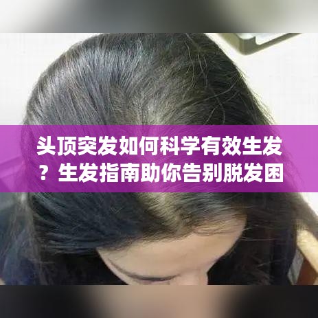 頭頂突發(fā)如何科學(xué)有效生發(fā)？生發(fā)指南助你告別脫發(fā)困擾！