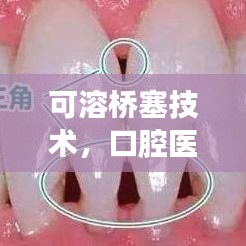 可溶橋塞技術，口腔醫(yī)療革新詳解